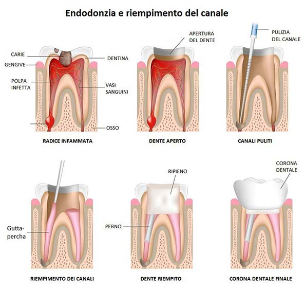Devitalizzazione dei denti a Brindisi - Centro Odontoiatrico Atena